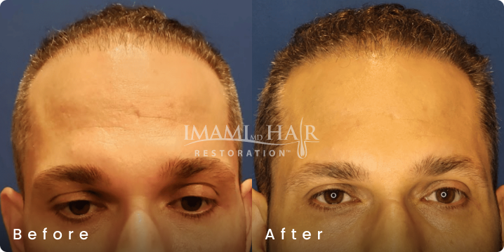 No shave FUE hair transplant before and after, age 39, Norwood 3