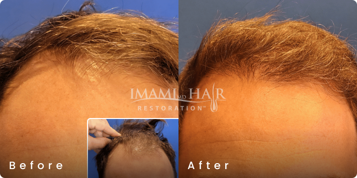No shave FUE hair transplant before and after, age 61, Norwood 4A