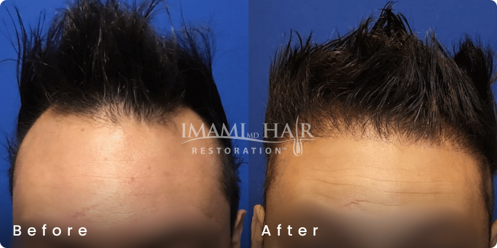 No shave FUE hair transplant before and after, age 32, Norwood 3