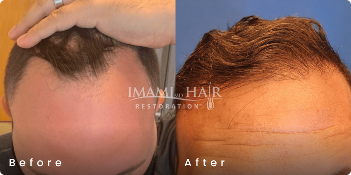No shave FUE hair transplant before and after, age 33, Norwood 3A, 1,750 grafts