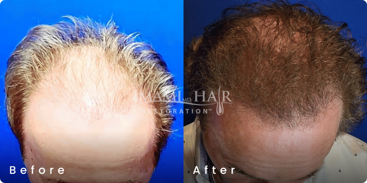 No shave FUE hair transplant before and after, age 66, Norwood 5, 1,350 grafts