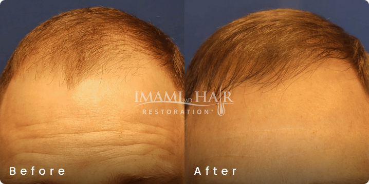 No shave FUE hair transplant before and after, age 38, Norwood 4, 2,023 grafts