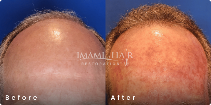 No shave FUE hair transplant before and after, age 55, Norwood 5, 1,800 grafts