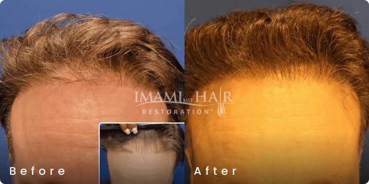 No shave FUE hair transplant before and after, age 61, Norwood 4A, 1,205 grafts