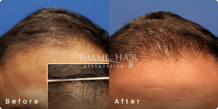 No shave FUE hair transplant before and after, age 39, Norwood 4A, 1,875 grafts